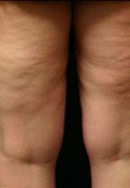 Viora Reaction For Front Thighs Cellulite - After