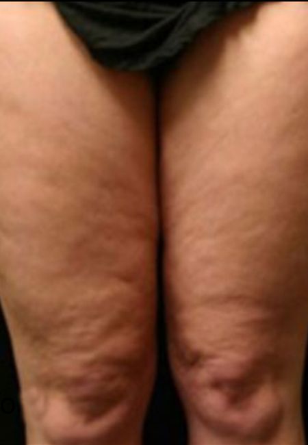 Viora Reaction For Front Thighs Cellulite - Before