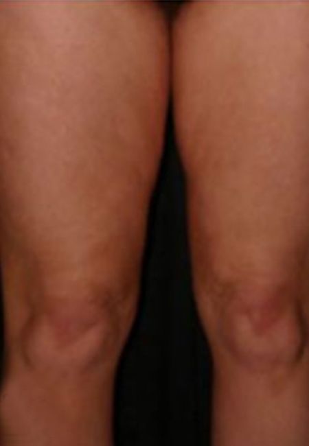 QWO Cellulite Treatment For Tight Thighs - Before
