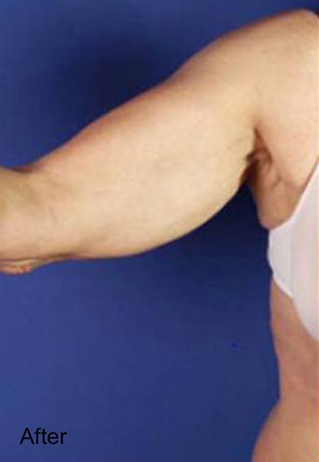 Cellulite Treatment For Arms - After