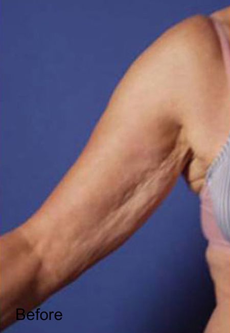 Cellulite Treatment For Arms - Before