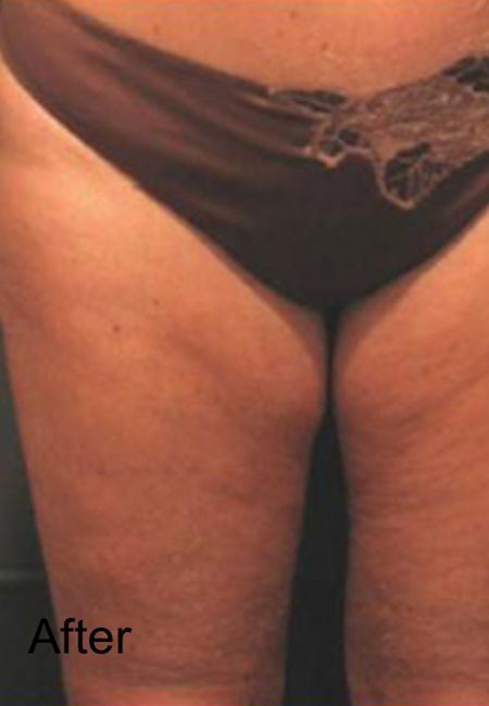 Cellulite Treatment For Front Of Legs - After