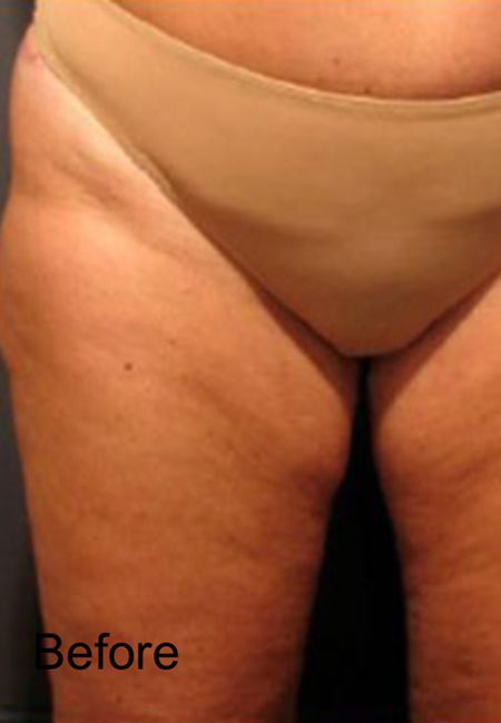 Cellulite Treatment For Front Of Legs - Before