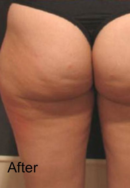 Cellulite Treatment For Front Of Legs - After