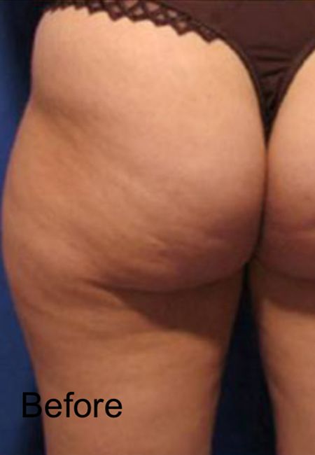 Cellulite Treatment For Hip - Before