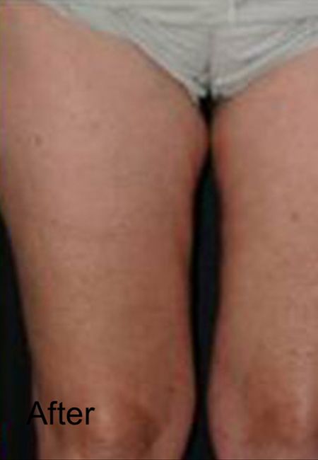 Non-surgical Cellulite Treatment - After