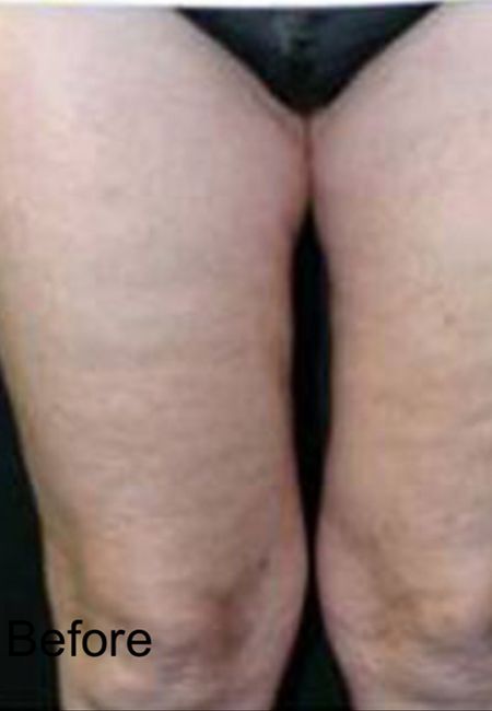 Non-surgical Cellulite Treatment - Before