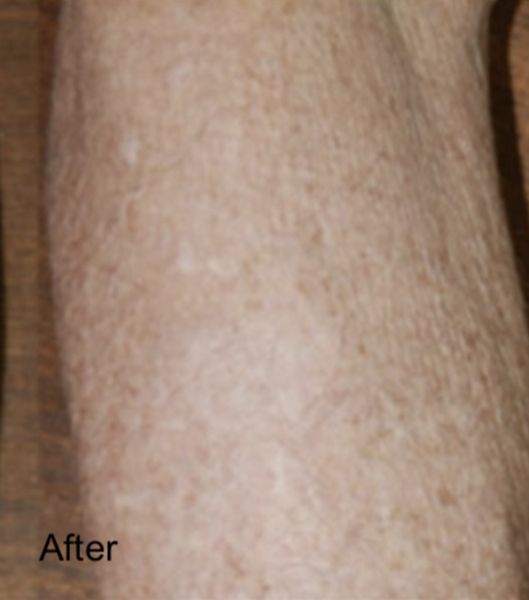 Carbon Dioxide Laser Resurfacing - After