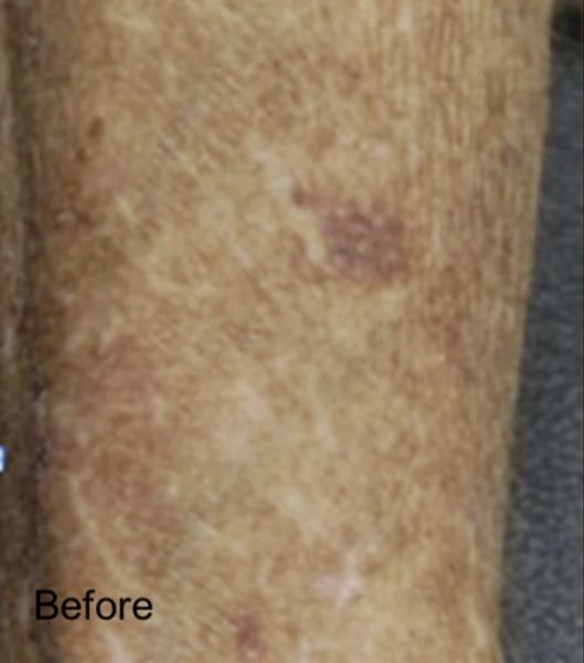 Carbon Dioxide Laser Resurfacing - Before