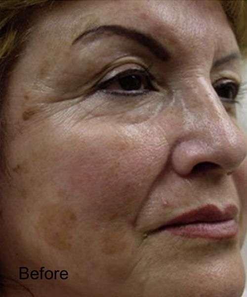 CO2 Laser Treatment For  Pigmentation - Before 