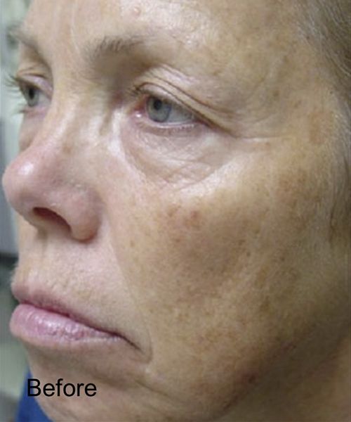 CO2 Laser Skin Rejuvenation - Before