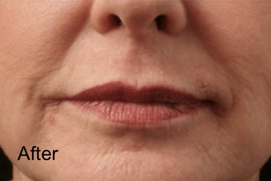 C02 Ablative Laser Resurfacing Treatment - After