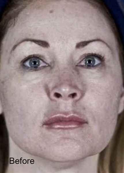 C02 Laser Resurfacing Treatment For Fine Lines and Wrinkles - Before