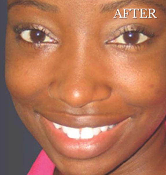 Chemical Peel Treatment for Acne Scars After