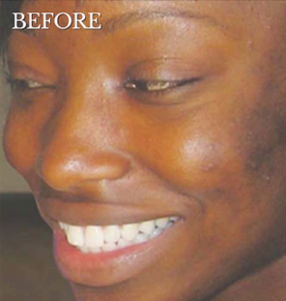 Chemical Peel Treatment for Acne Scars Before