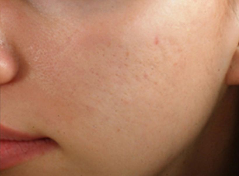 Radiofrequency Microneedling for Acne Scars - After