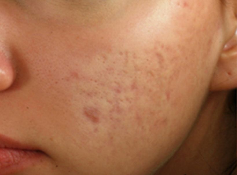 Radiofrequency Microneedling for Acne Scars - Before