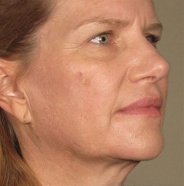 Viora VST Skin Tightening Treatment - After