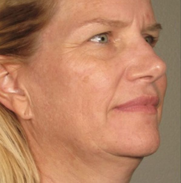 Viora VST Skin Tightening Treatment - Before