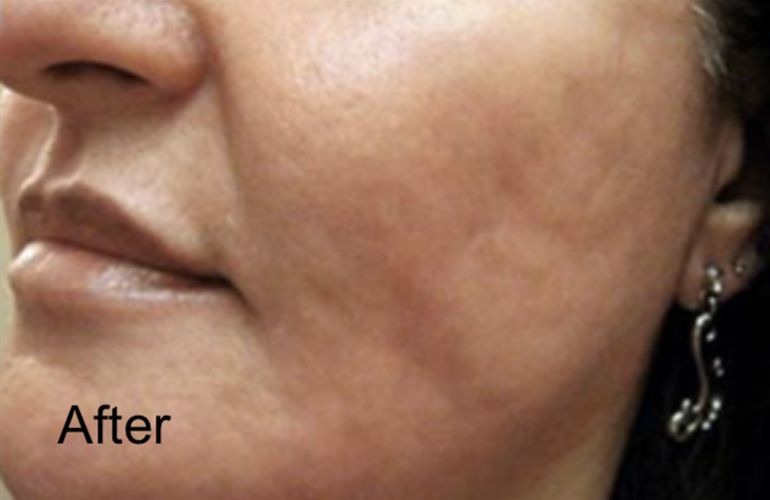 Fractional CO2 Laser For Open Pore Reduction and Acne scars - After 