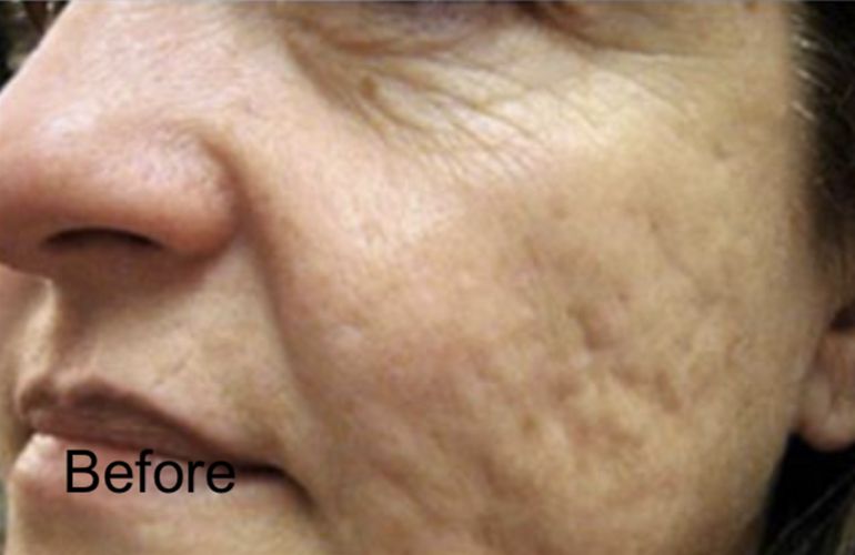 Fractional CO2 Laser For Open Pore Reduction and Acne scars - Before 