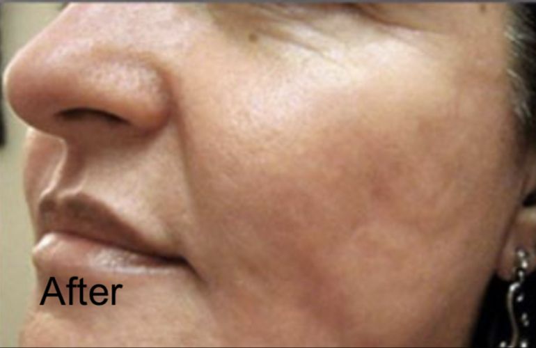 C02 Laser Skin Resurfacing For Open Pores And Mild Acne scars - After