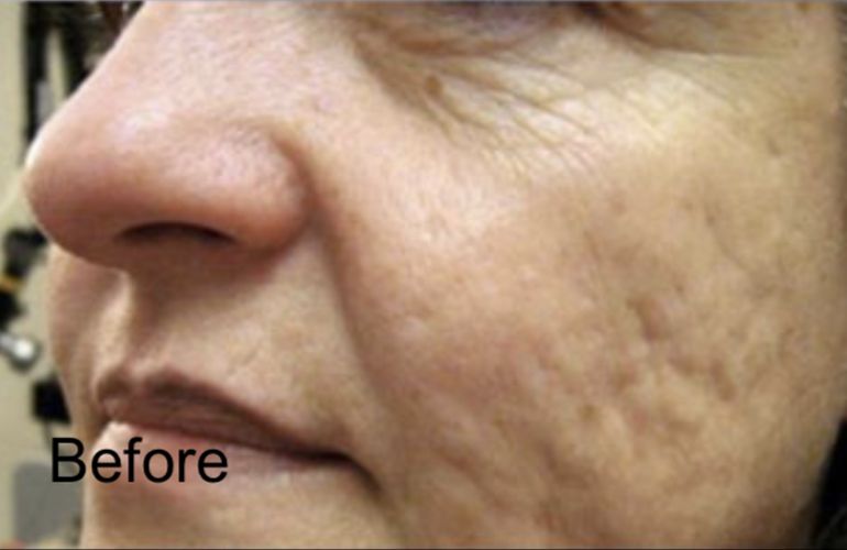 C02 Laser Skin Resurfacing For Open Pores And Mild Acne scars - Before