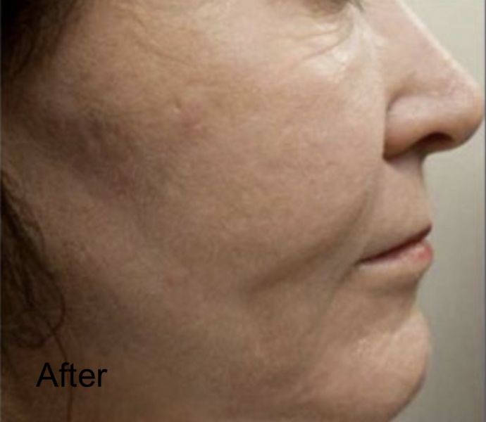 C02 Laser Skin Resurfacing For Open Pores And Wrinkles - After