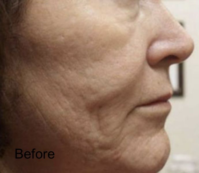 C02 Laser Skin Resurfacing For Open Pores And Wrinkles - Before