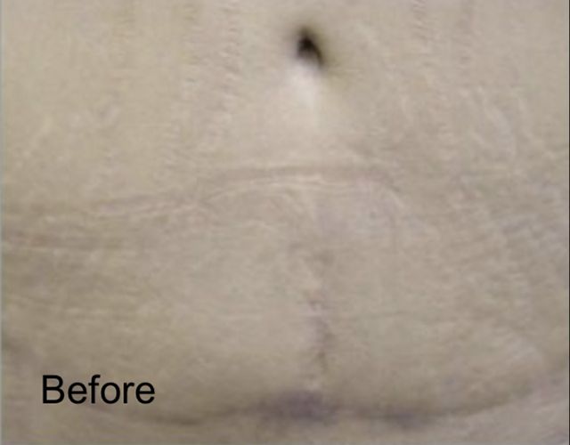 CO2 Laser Resurfacing For Stretch Marks - Before 