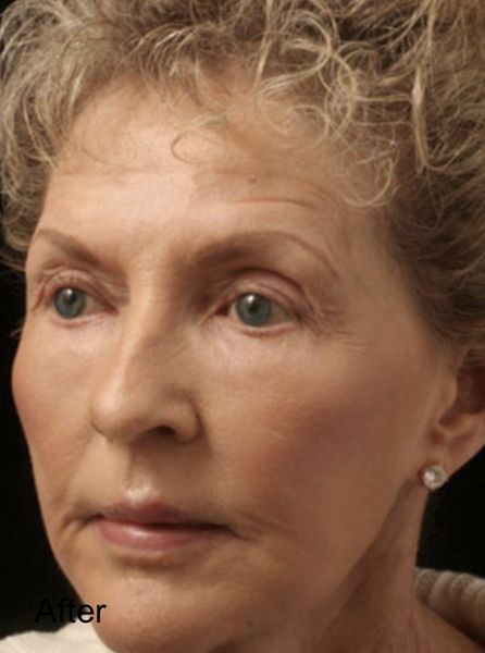 CO2 Fractional Laser Resurfacing Treatment - After 