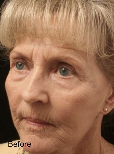CO2 Fractional Laser Resurfacing Treatment - Before