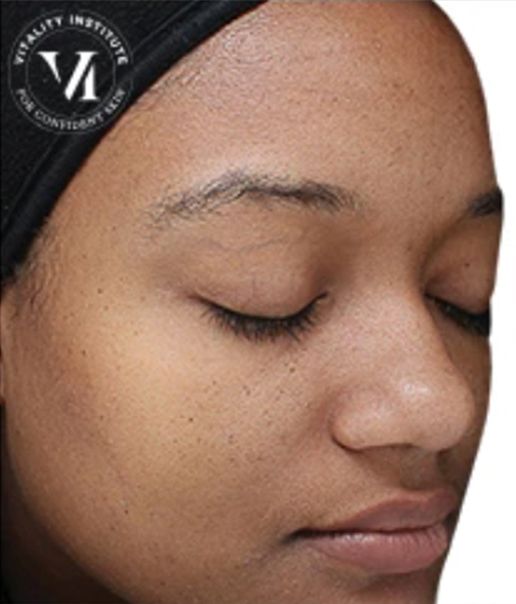 Superficial Chemical Peel Treatment for Acne Scars -After