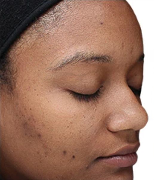 Superficial Chemical Peel Treatment for Acne Scars - Before