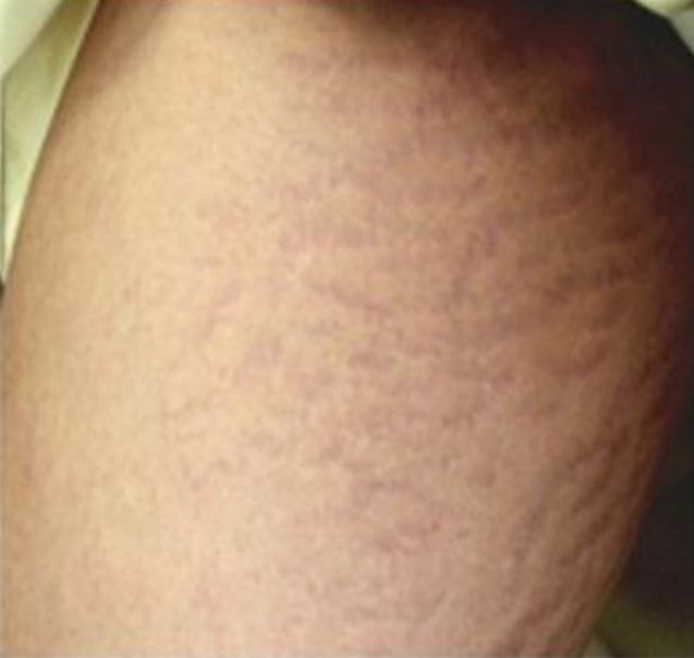 Microneedling to Reduce Stretch Marks - After