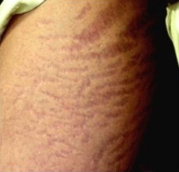 Microneedling to Reduce Stretch Marks - Before