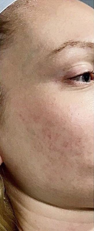 PRP Treatment for Acne Scars  - Before