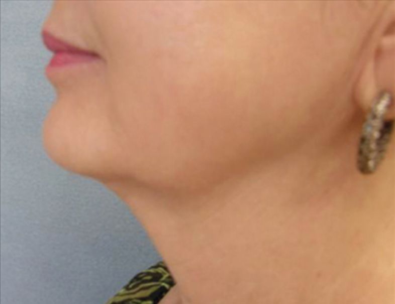 Relift Skin Tightening and Fat Melting Lower Face - After
