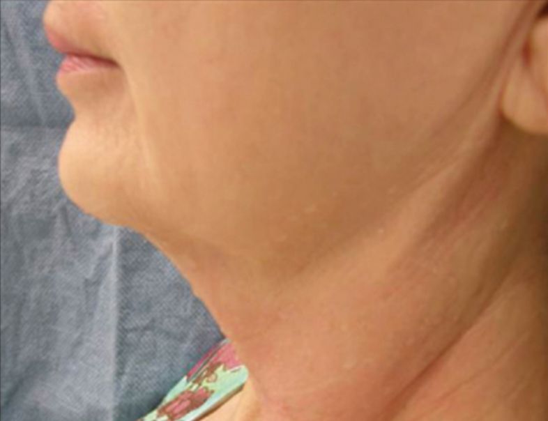 Relift Skin Tightening and Fat Melting Lower Face - Before