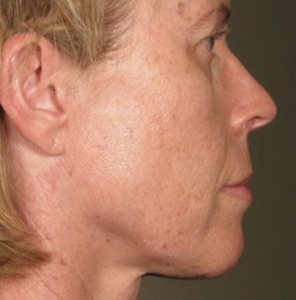 Viora VST Laser Skin Treatment - After