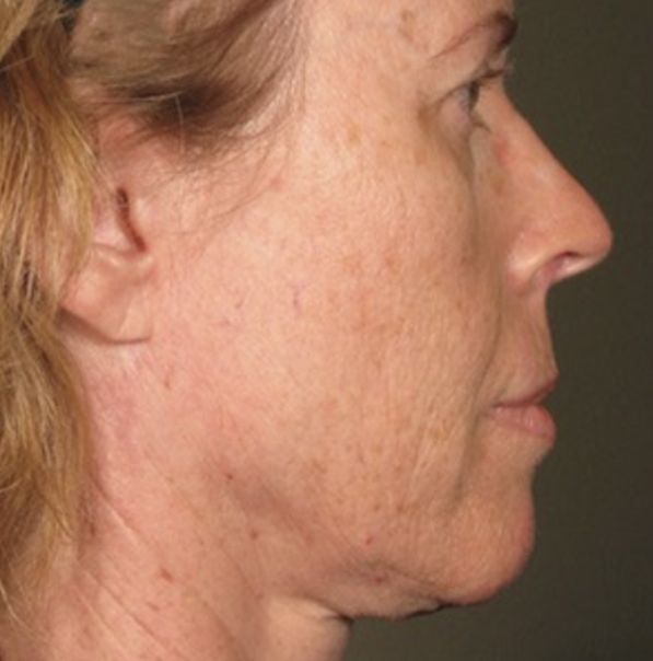 Viora V-Lift Laser Face and Neck Lifting - Before