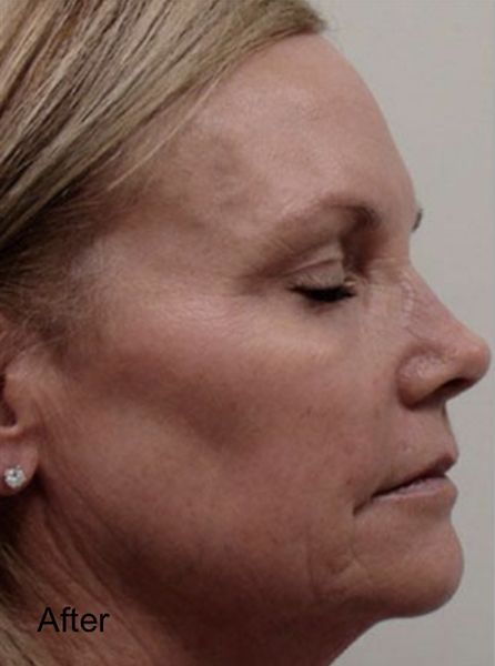 CO2 Fractional Laser Resurfacing Treatment - After