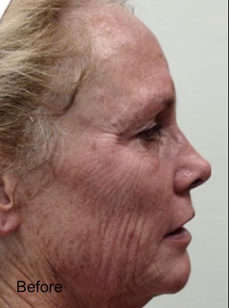 CO2 Fractional Laser Resurfacing Treatment - Before 