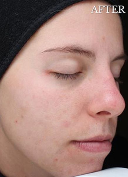 Deep Chemical Peel Treatment for Acne Scars After