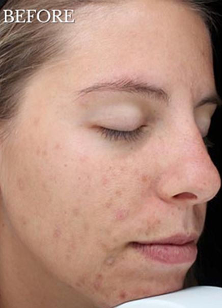 Deep Chemical Peel Treatment for Acne Scars Before