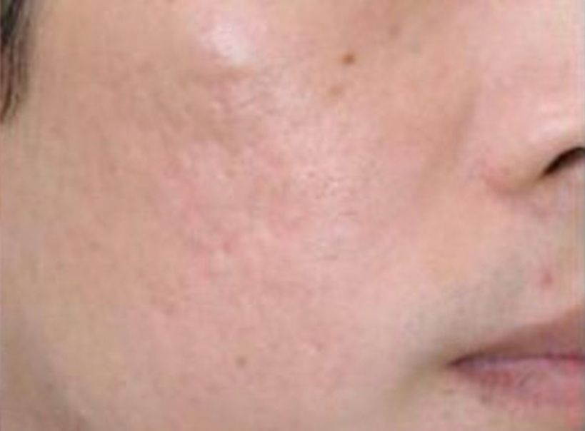 SkinPen Microneedling for Acne Scars  - After