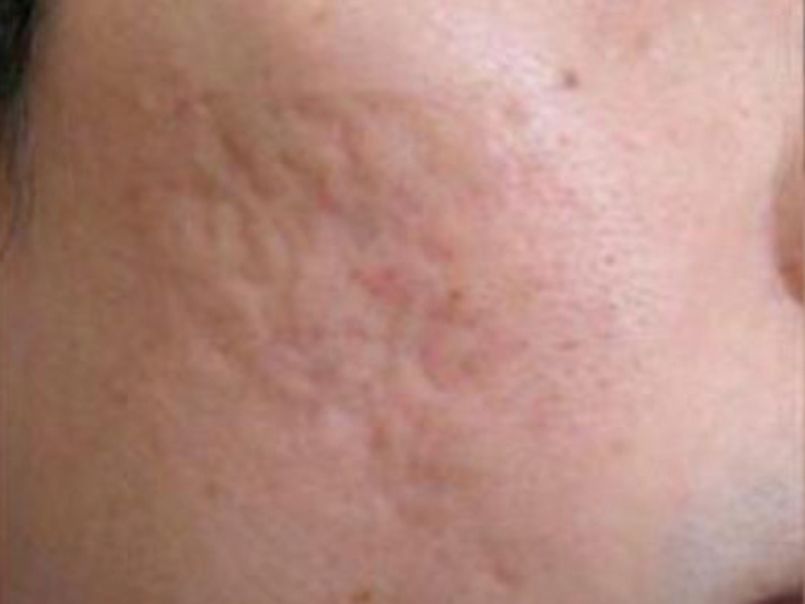 SkinPen Microneedling for Acne Scars  - Before