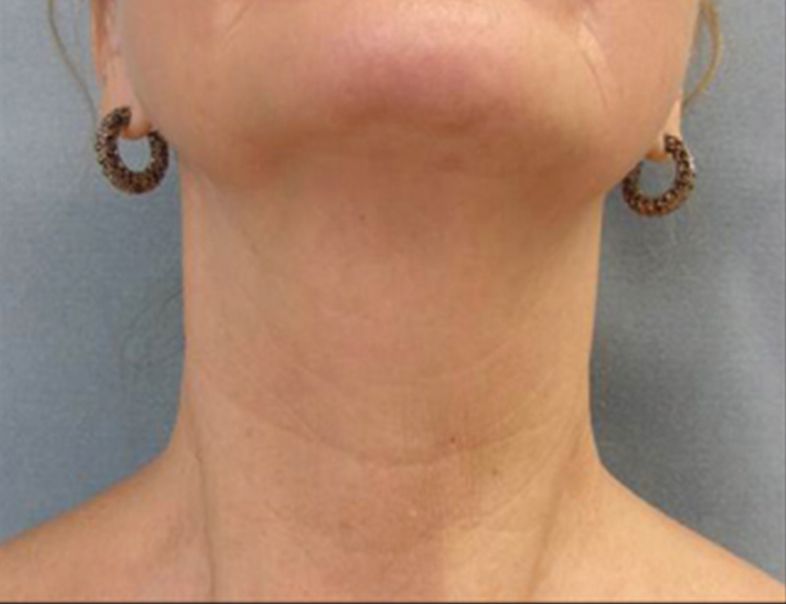 Ultrasound Skin Tightening and Fat Melting Lower Face - After
