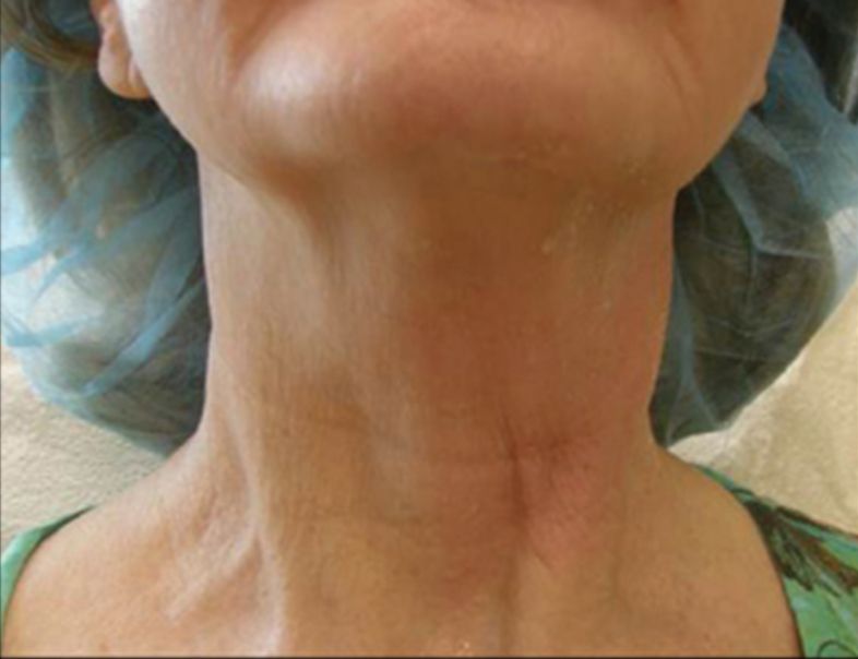 Ultrasound Skin Tightening and Fat Melting Lower Face - Before 