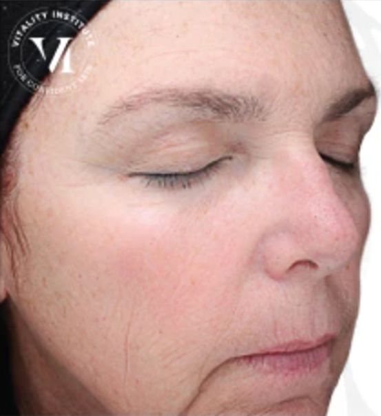Medium Depth Chemical Peel Treatment for Acne Scars After